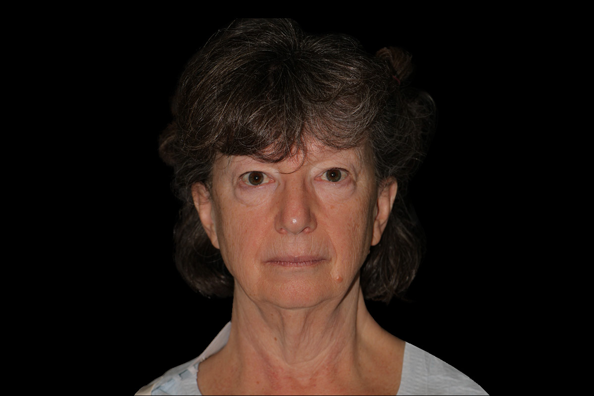 Before Face and Neck - Front View