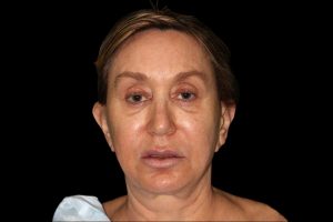 Before Face and Neck - Front View