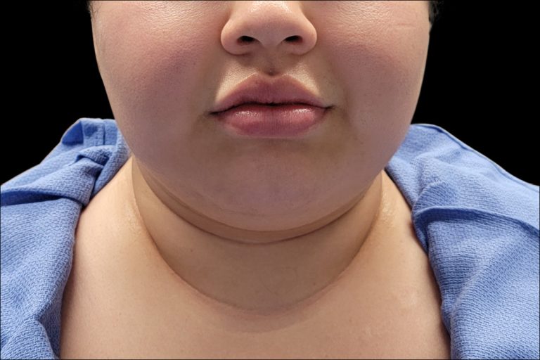 Before Face and Neck - Front View
