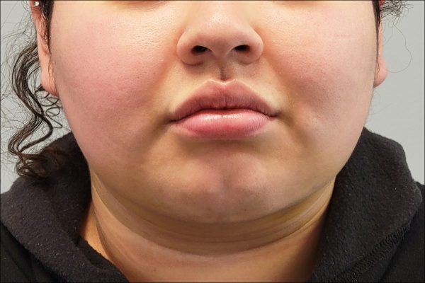 After Face and Neck - Front View
