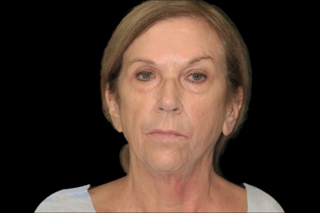 Before Face and Neck - Front View