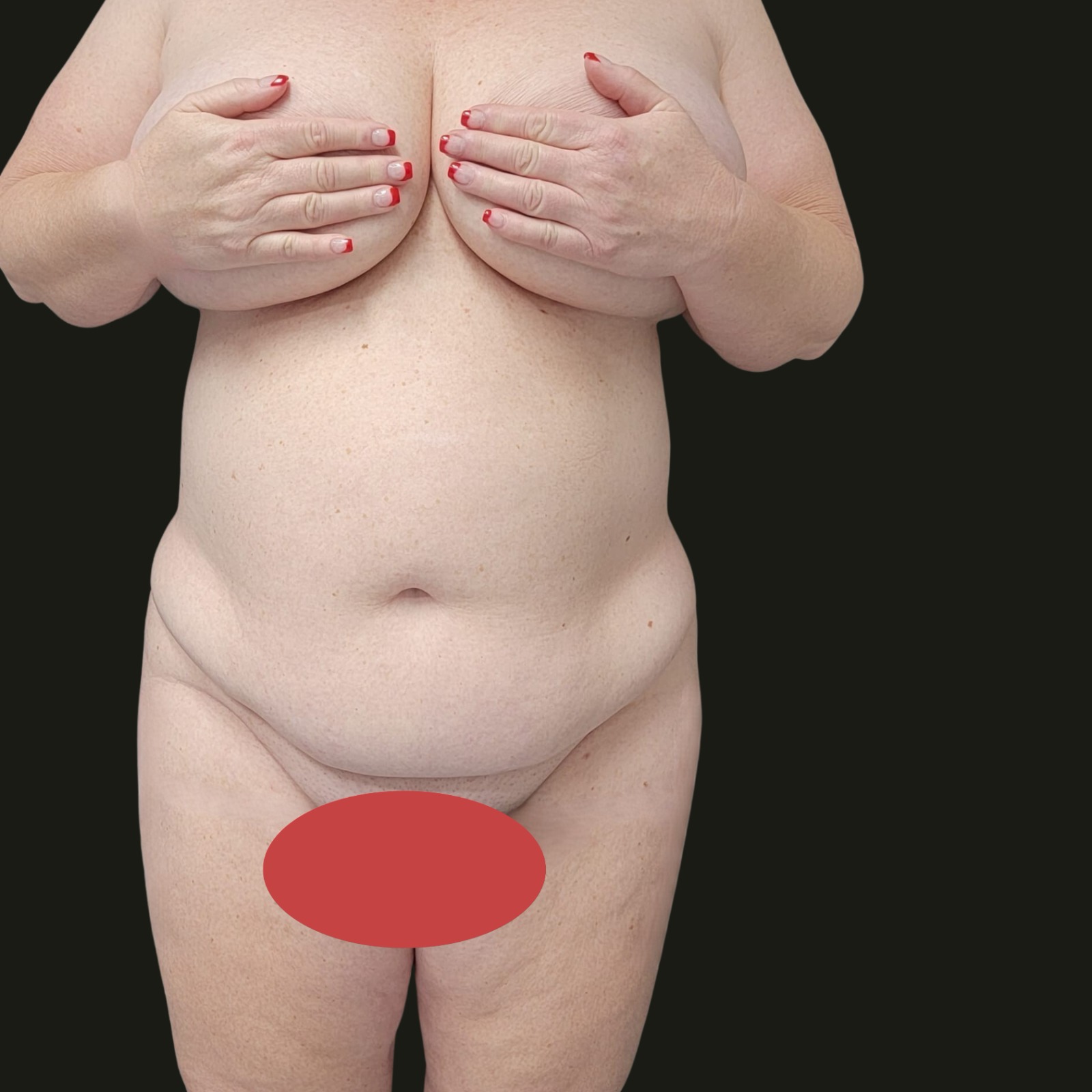 Before Tummy Tuck - Front View