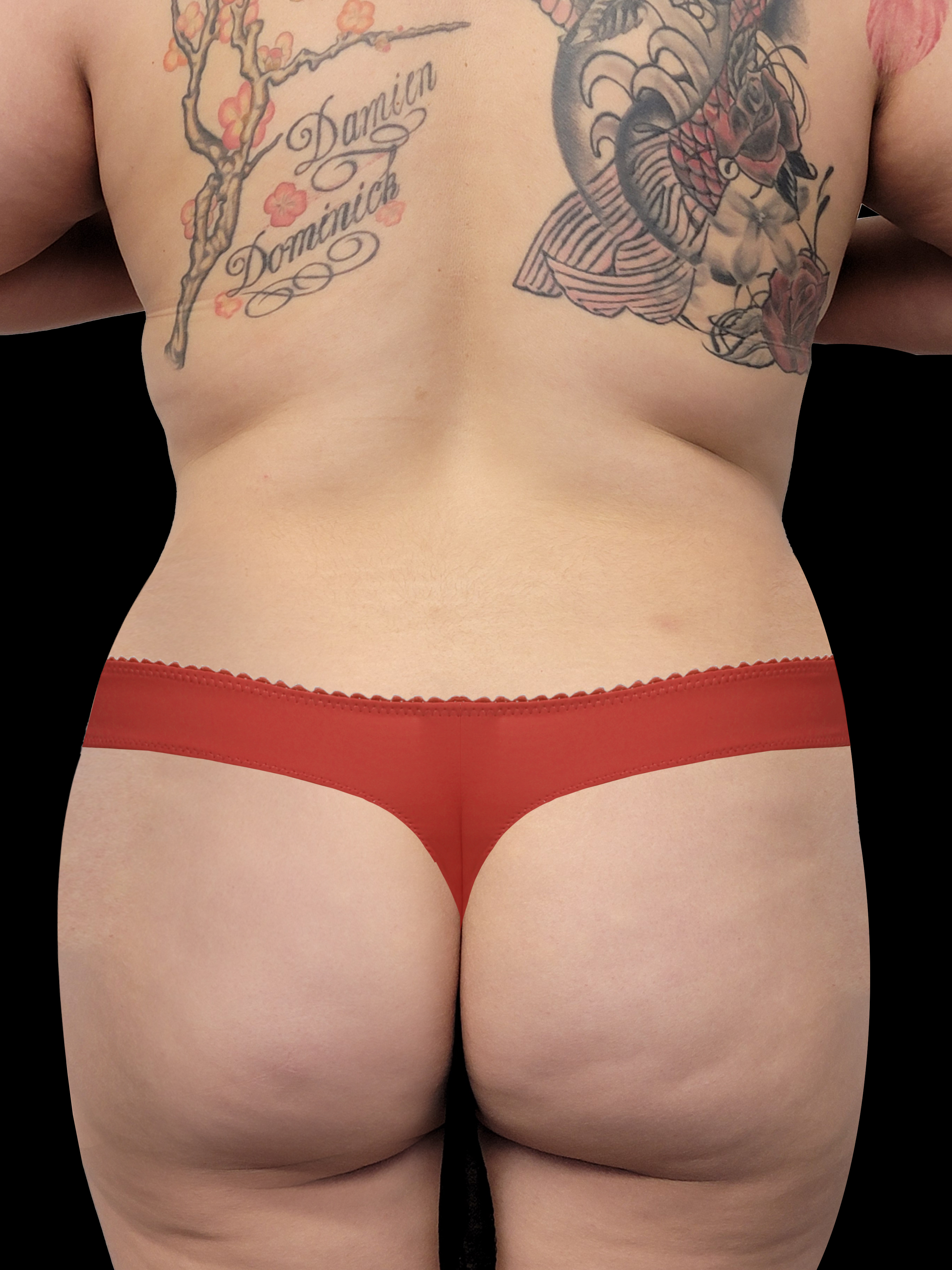 Before Brazillian Butt Lift - Back View