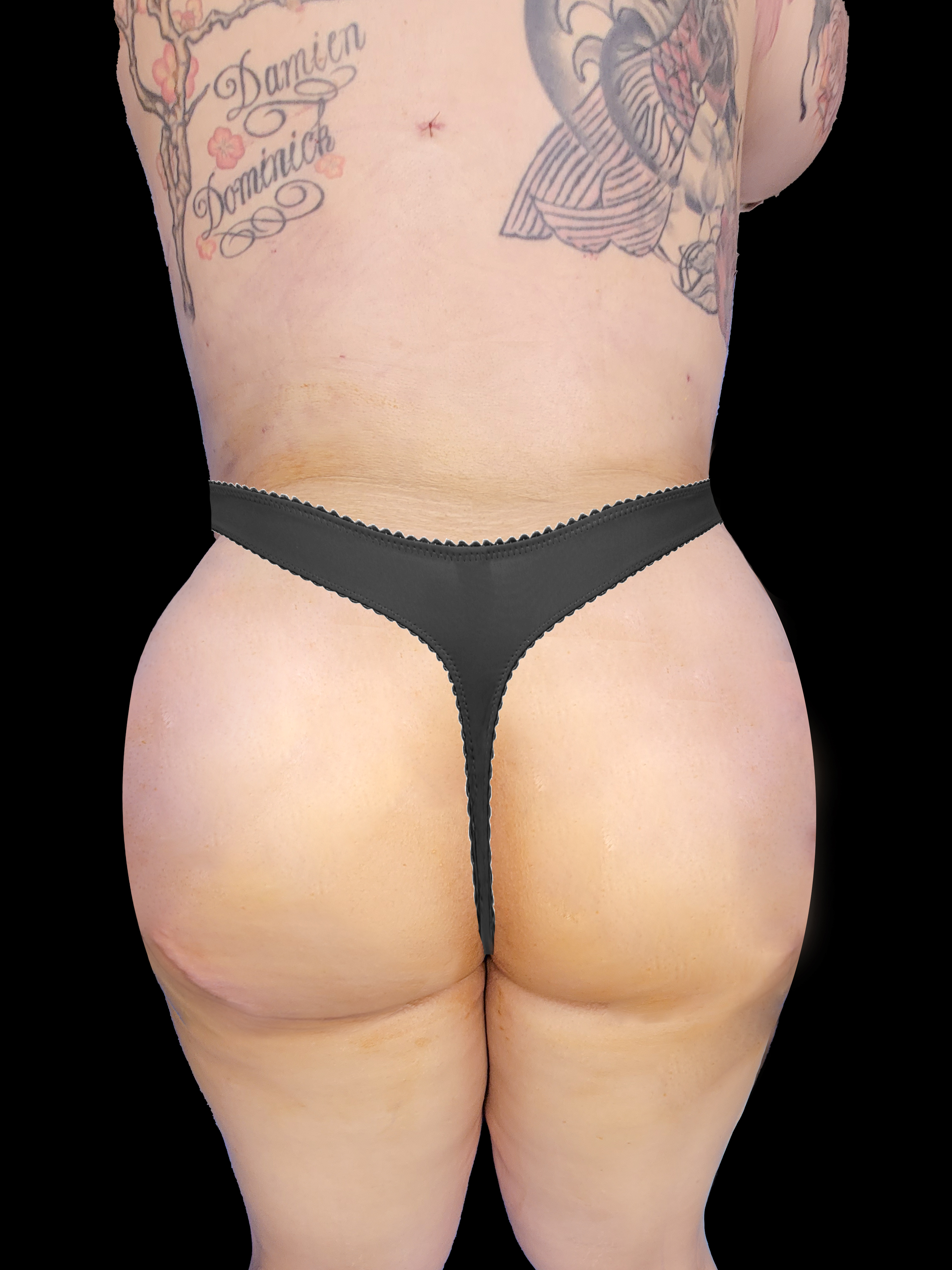 After Brazillian Butt Lift - Back View