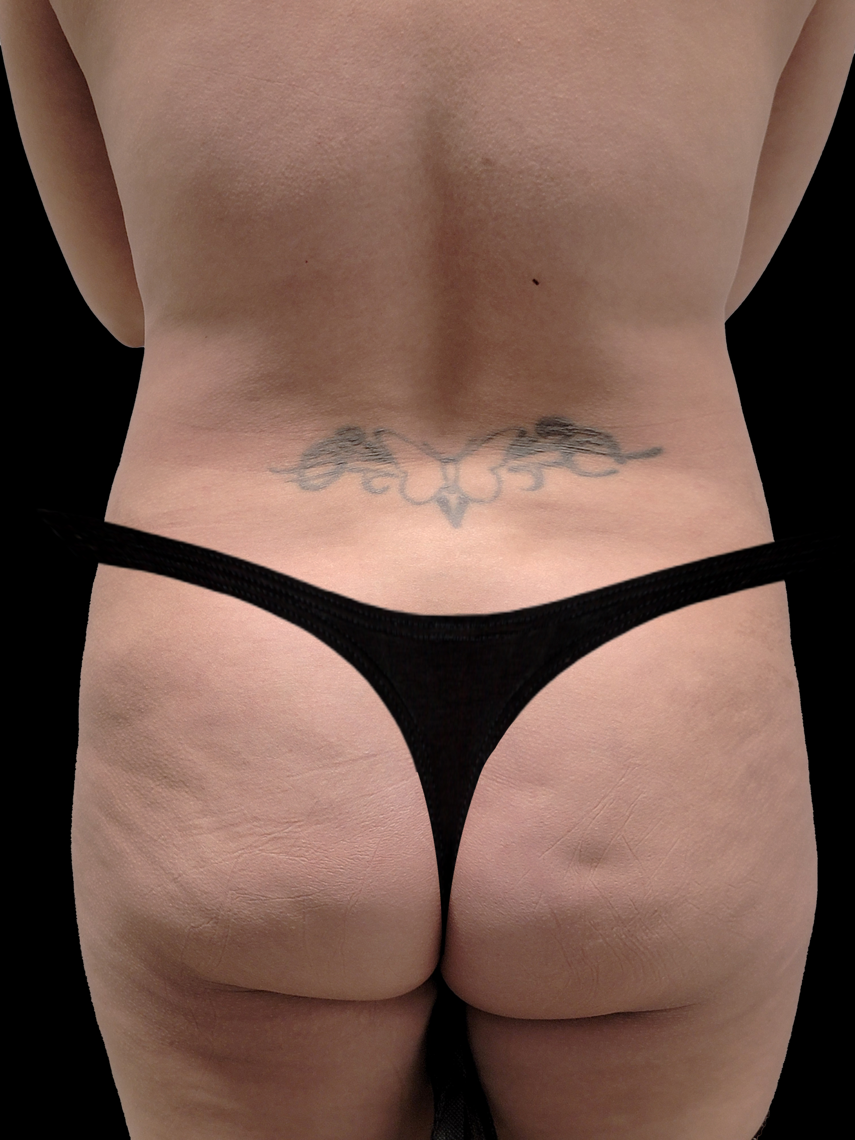 Before Brazillian Butt Lift - Back View