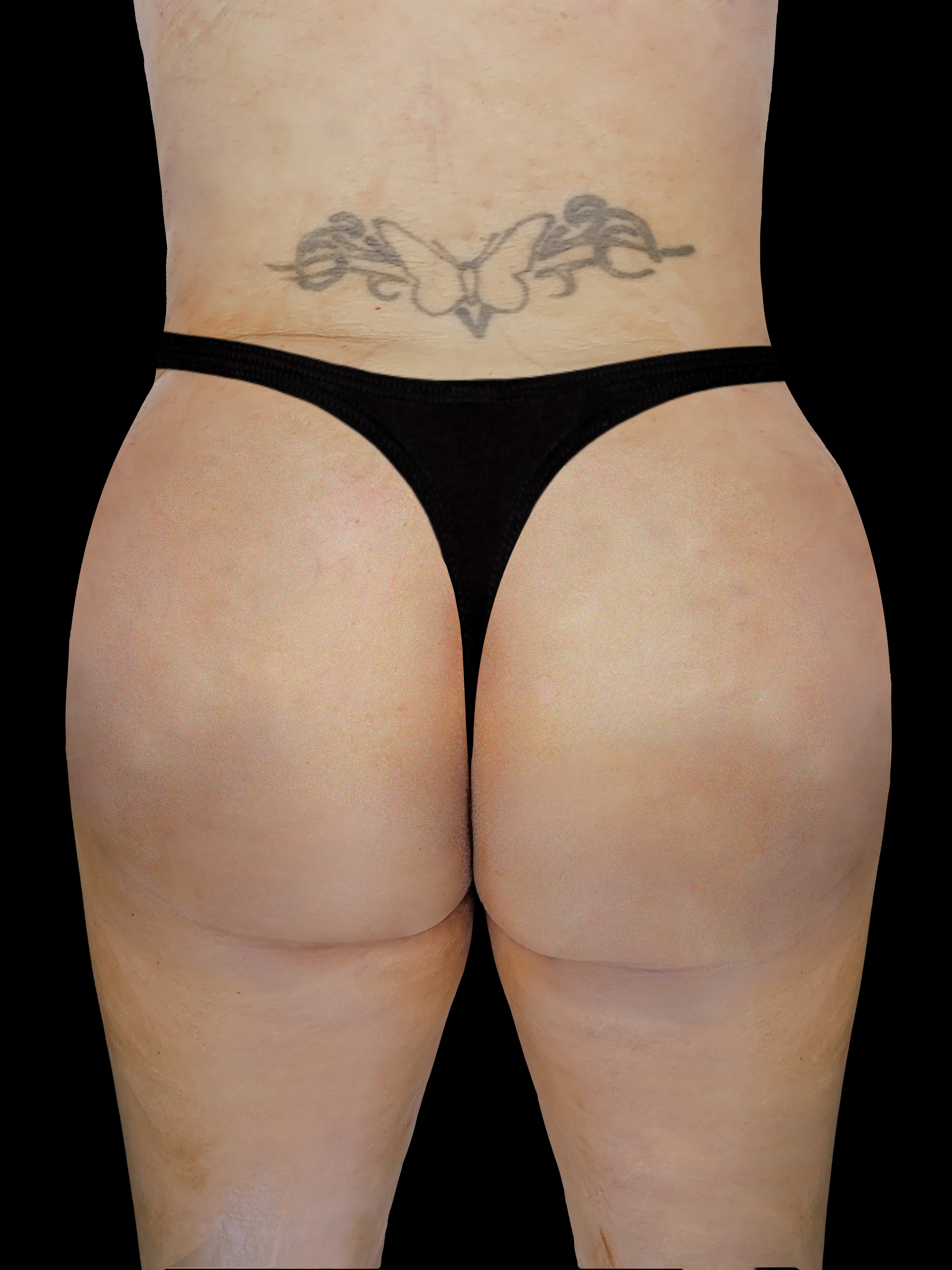After Brazillian Butt Lift - Back View