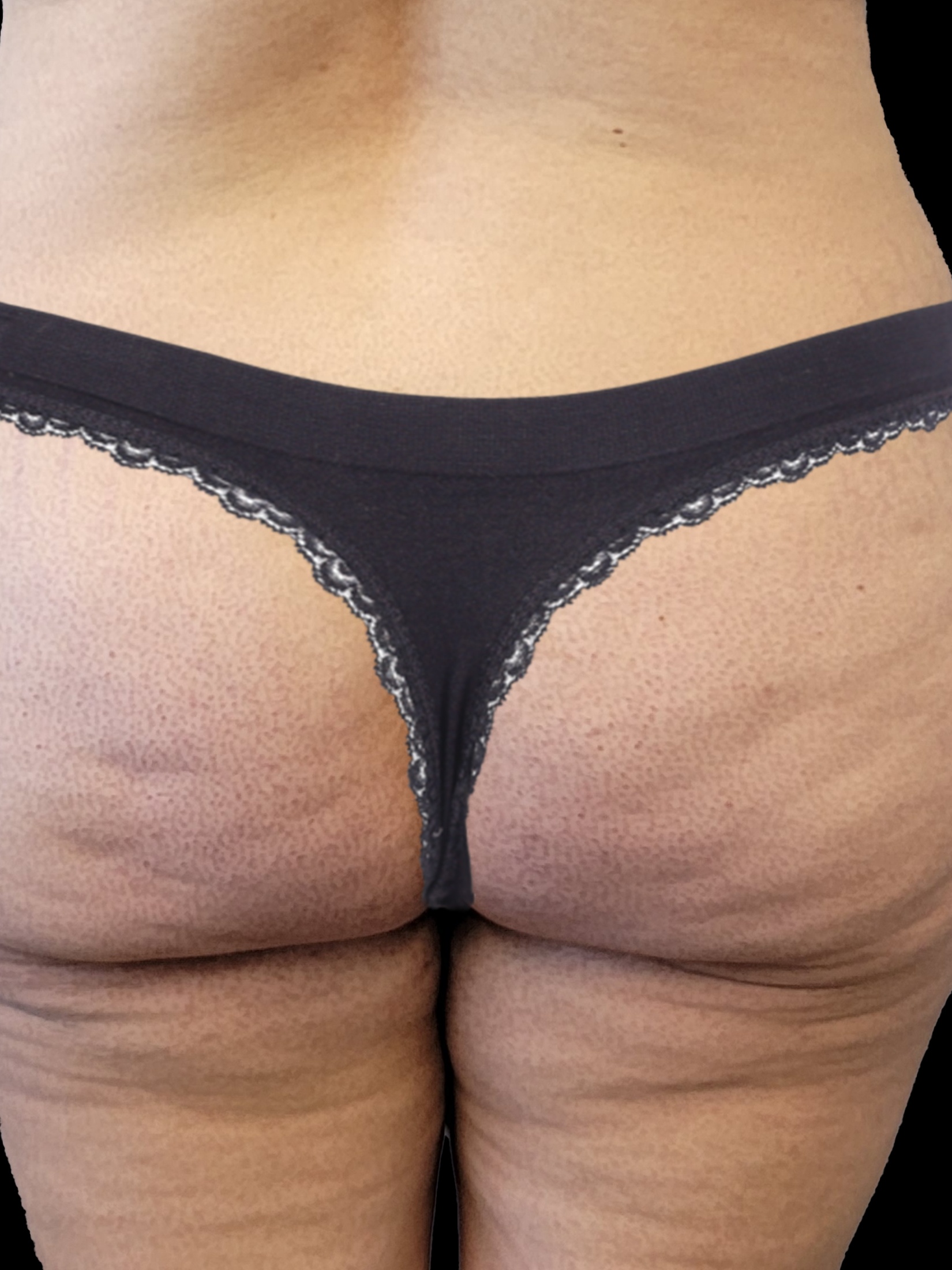 Before Brazillian Butt Lift - Back View