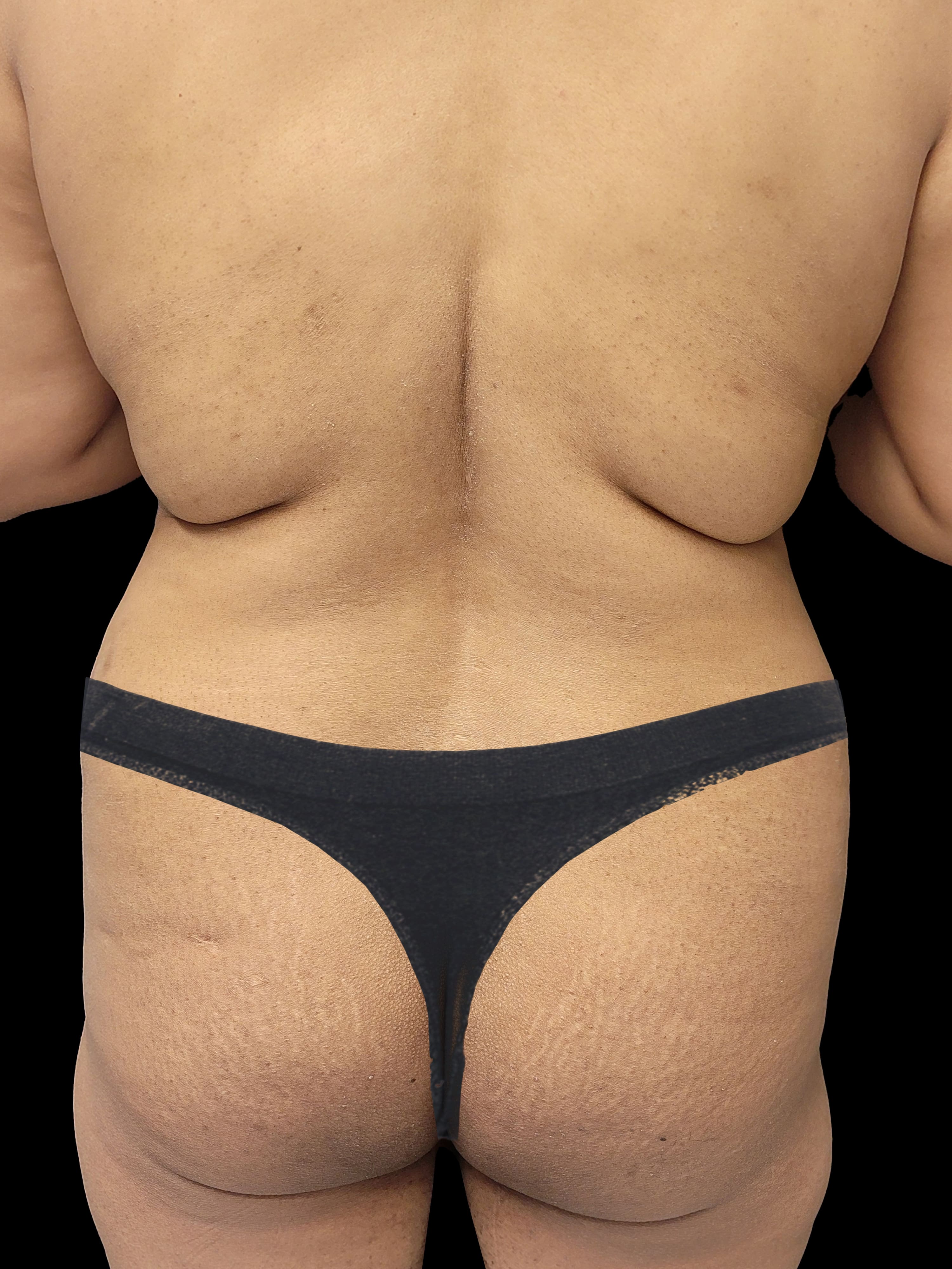 Before Body Lift - Back View