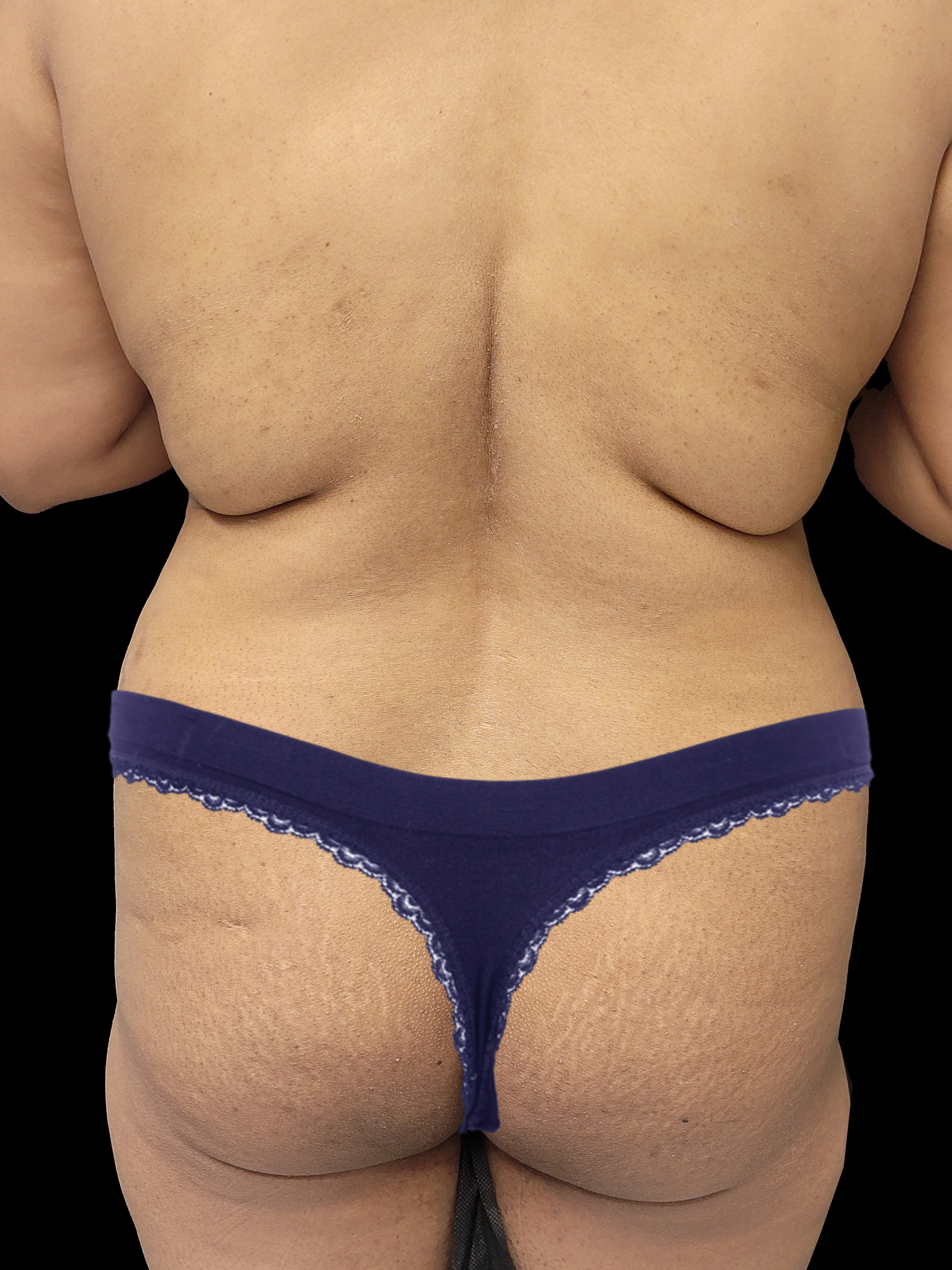 Before Brazillian Butt Lift - Back View