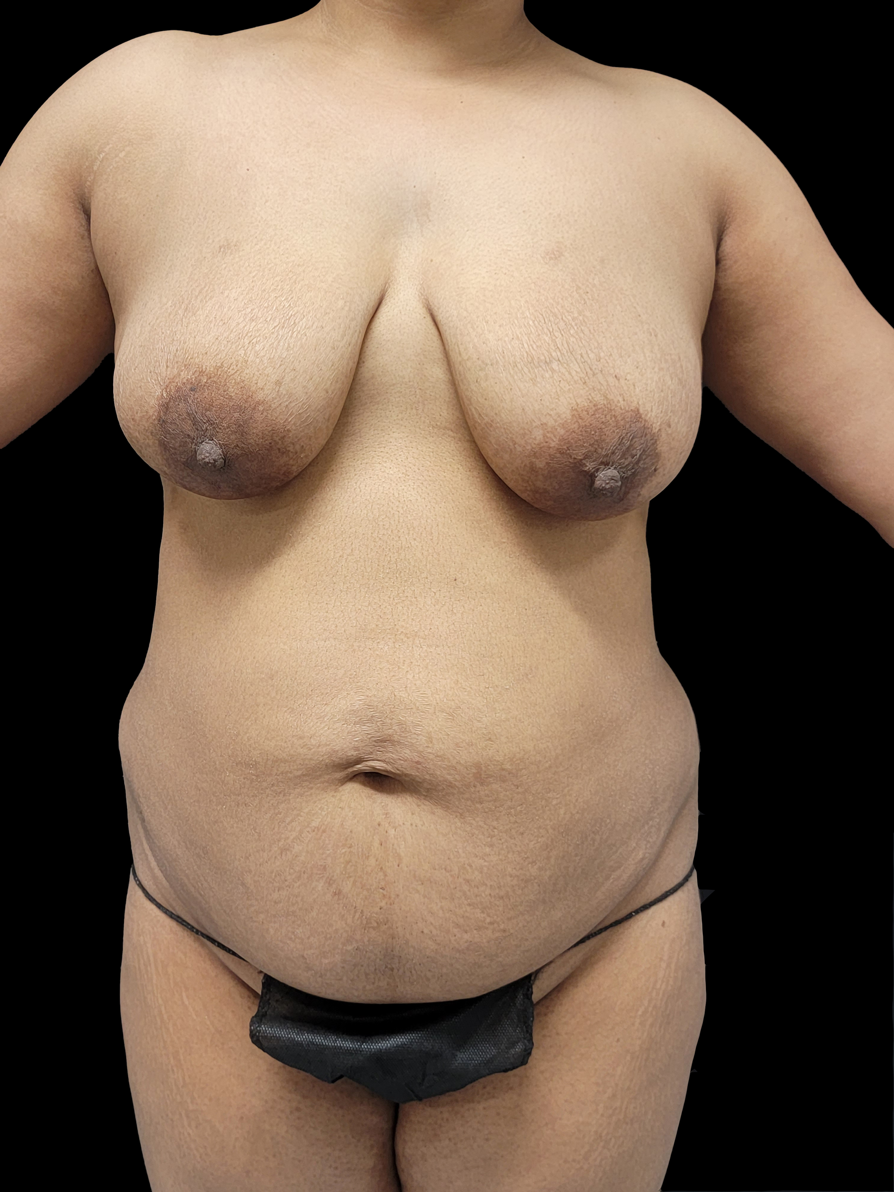 Before Mommy Makeover - Front View