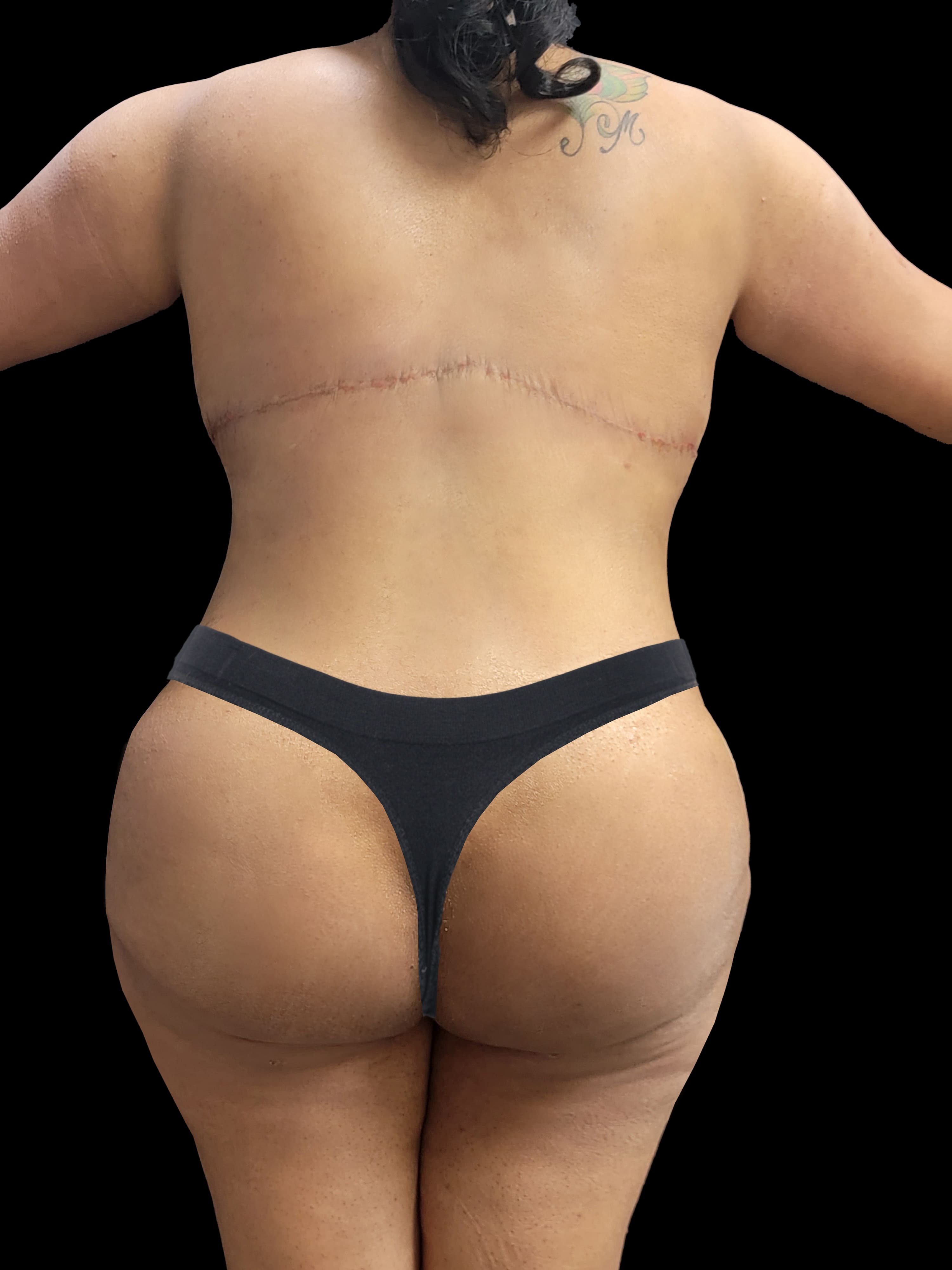 After Body Lift - Back View