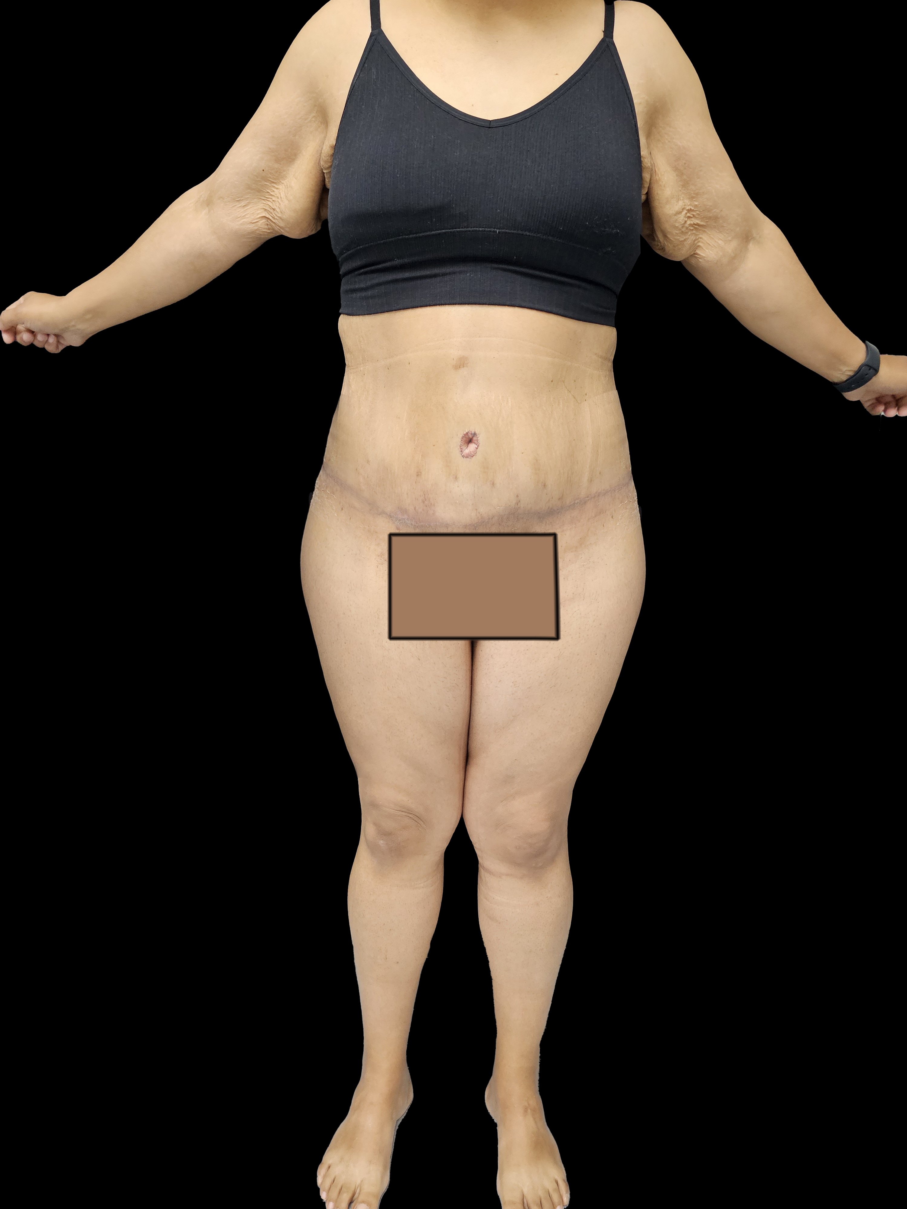 After Body Lift - Front View