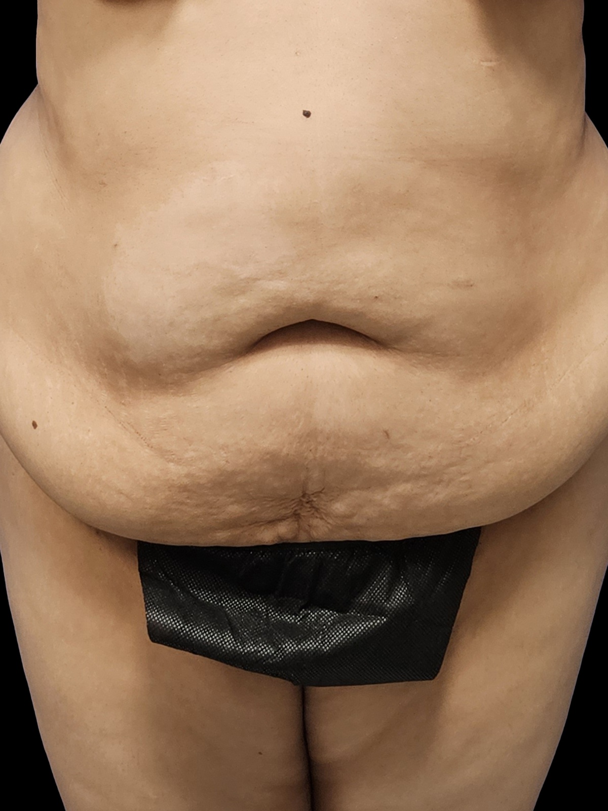 Before Tummy Tuck - Front View