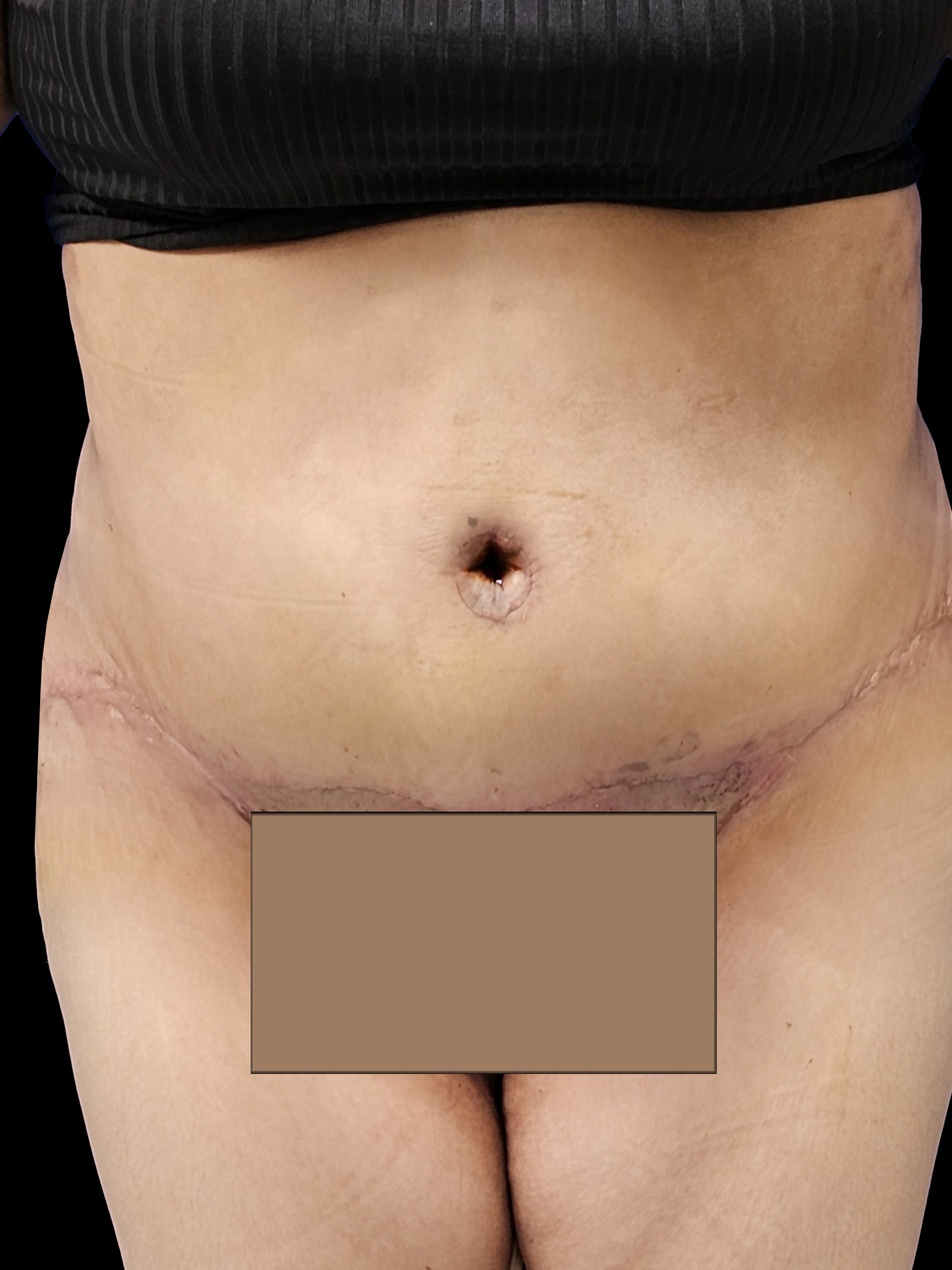 After Tummy Tuck - Front View