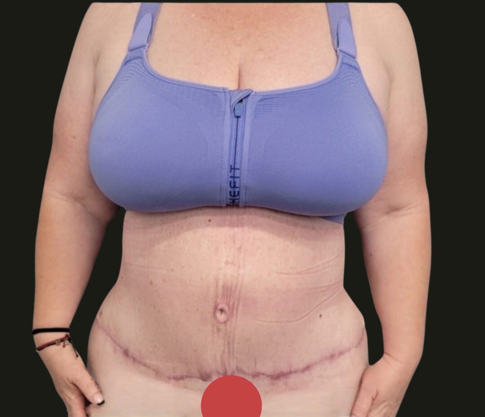 After Tummy Tuck - Front View
