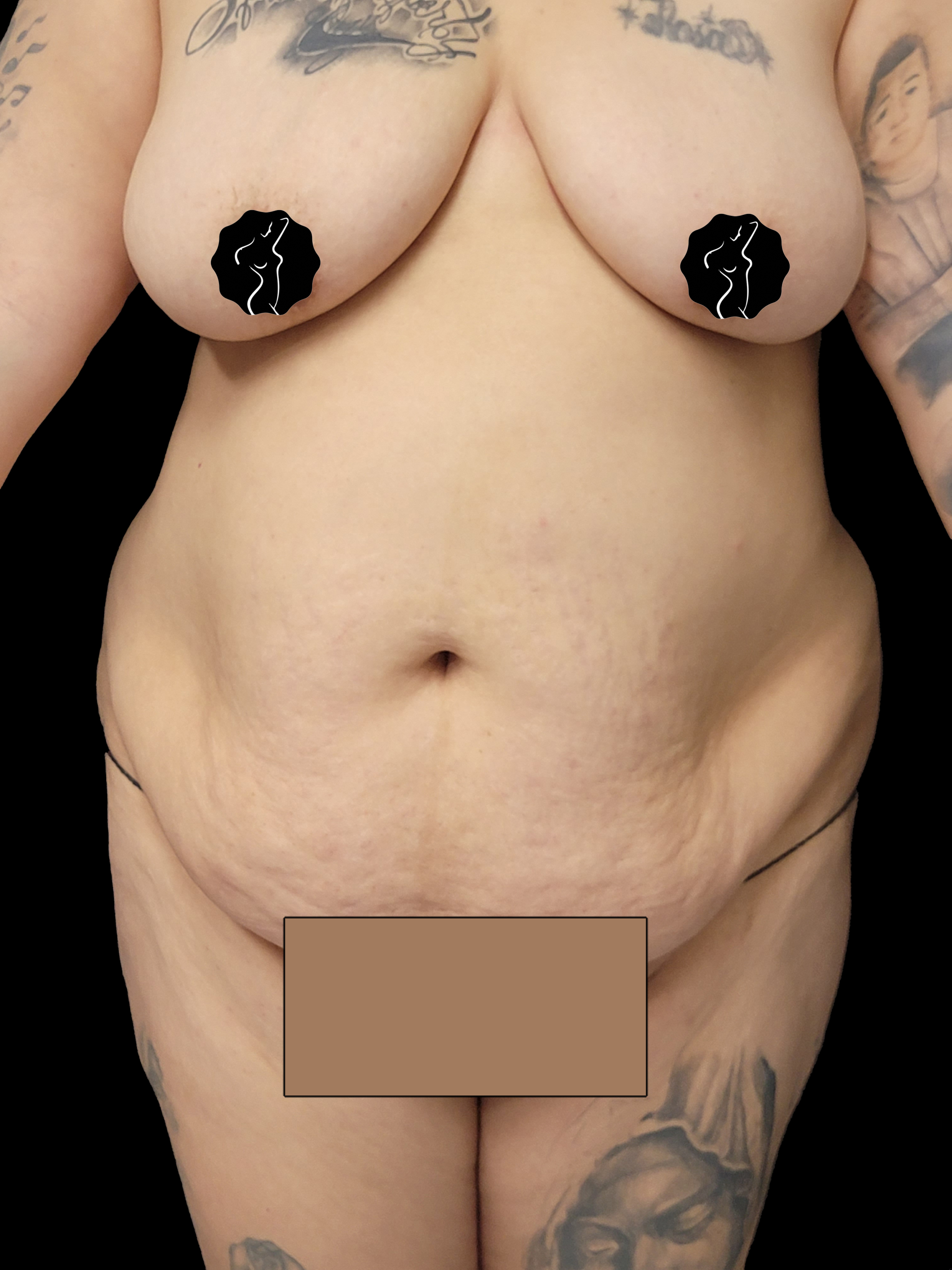 Before Tummy Tuck - Front View