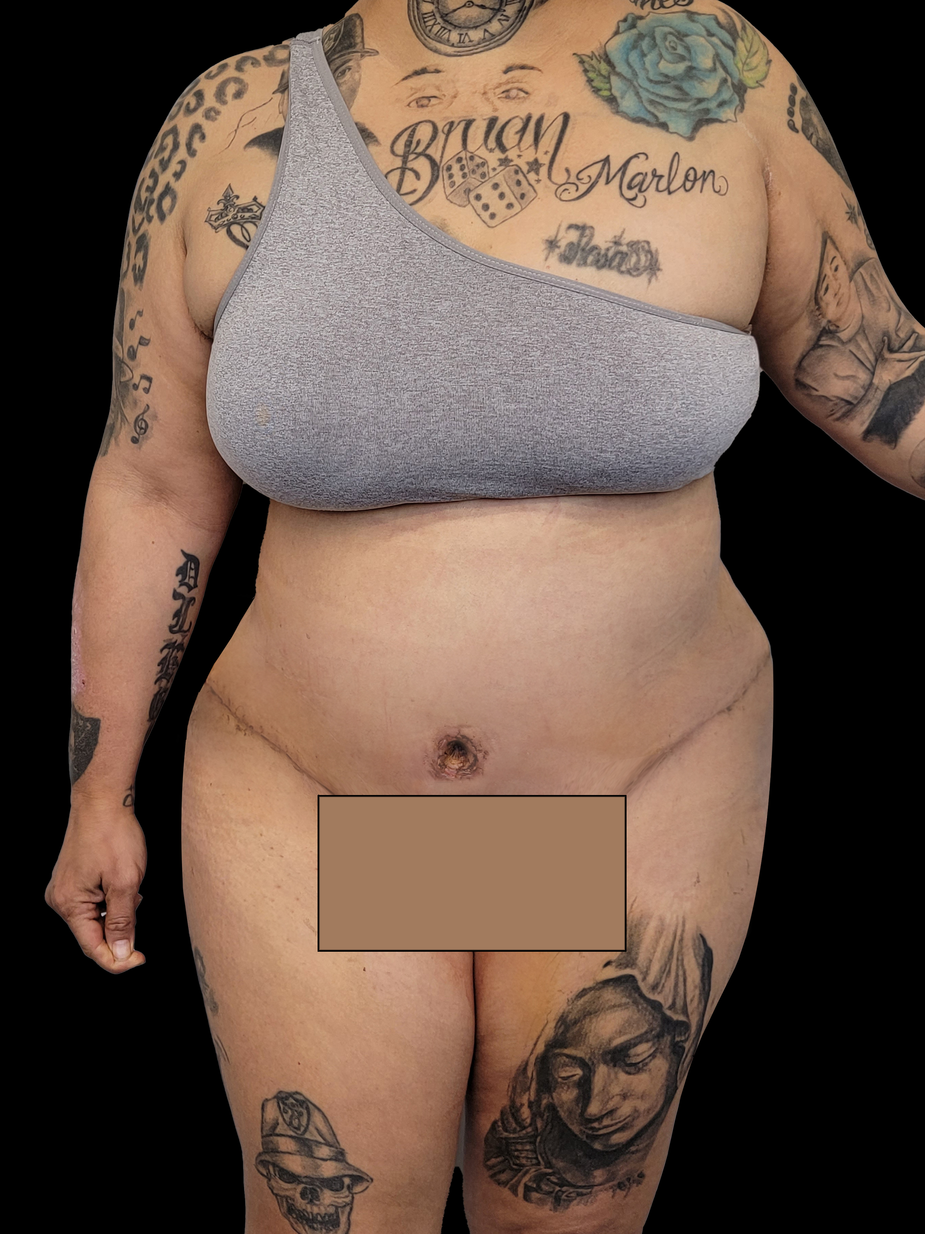 After Tummy Tuck - Front View