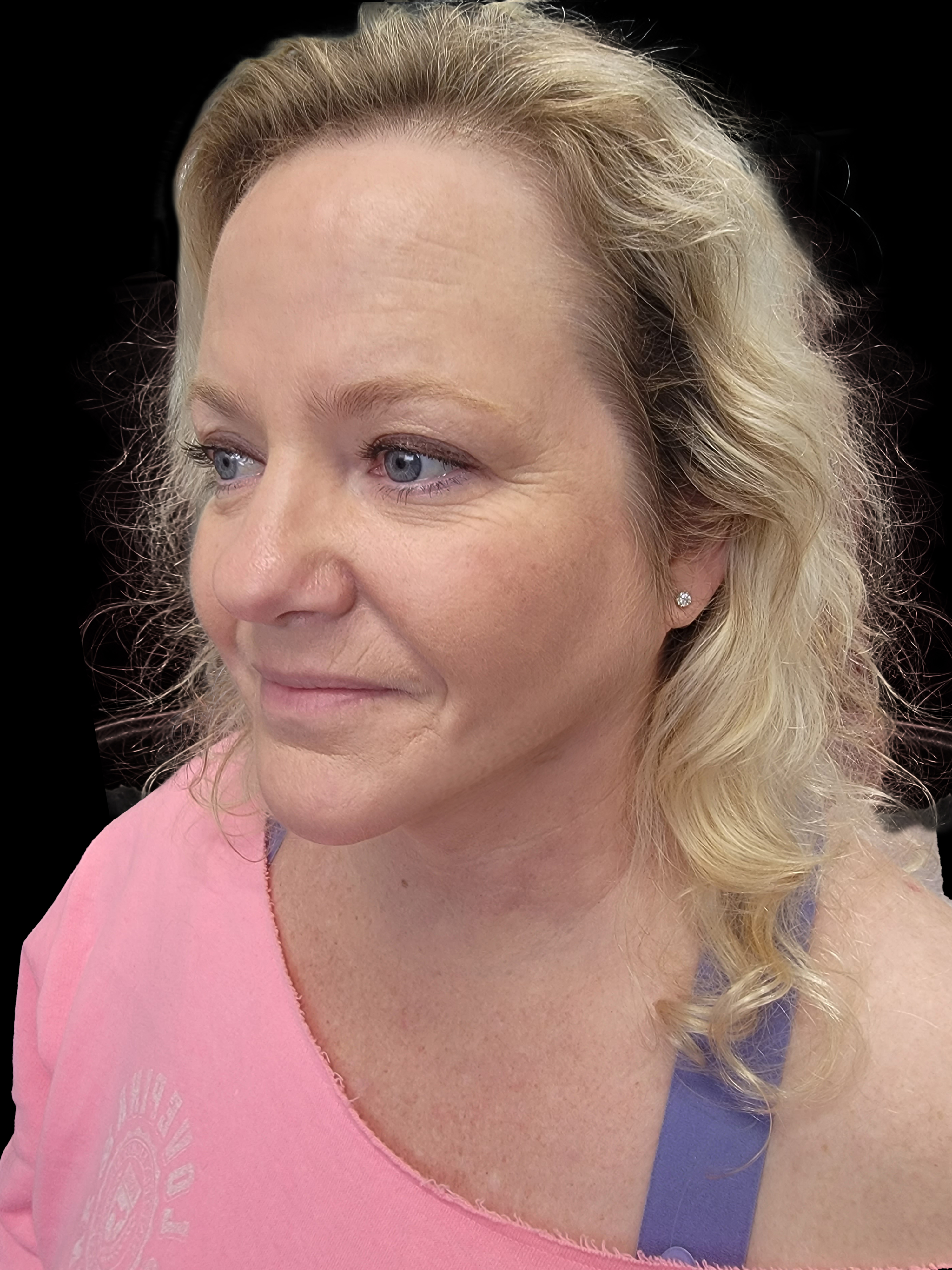 After Face and Neck - Front View