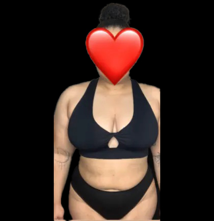 After Lipo 360 - Front View