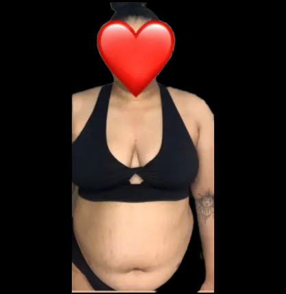 Before Lipo 360 - Front View
