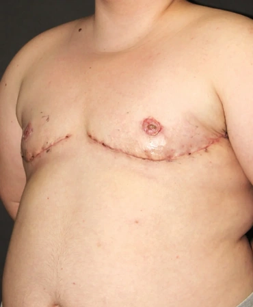 FTM Top Surgery After Transformation