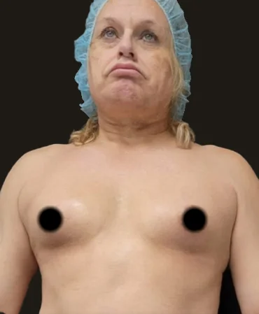 Breast Surgery Before Transformation