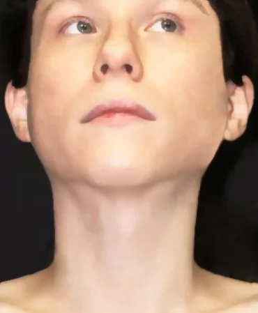 Facial Surgery After Transformation