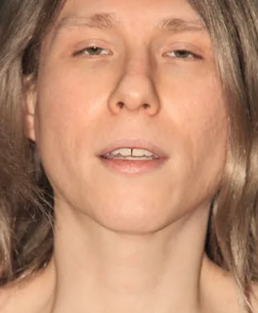 Facial Surgery Before Transformation